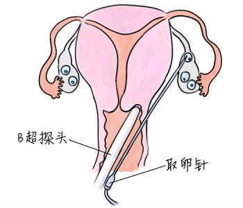 小儿退烧推拿手法 5种绍兴捐卵宝宝退烧按摩方法